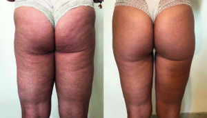 Trattamento di tecar estetico contro la cellulite